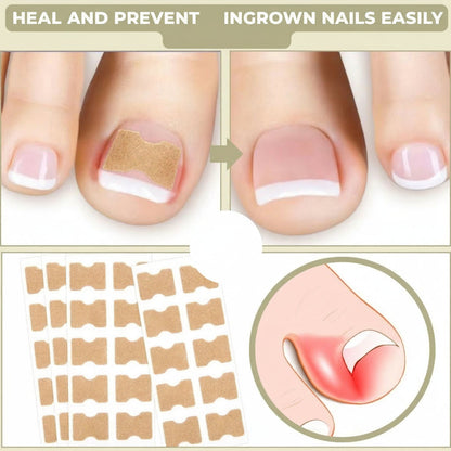 Toenail Corrector Patches Ingrown Nail