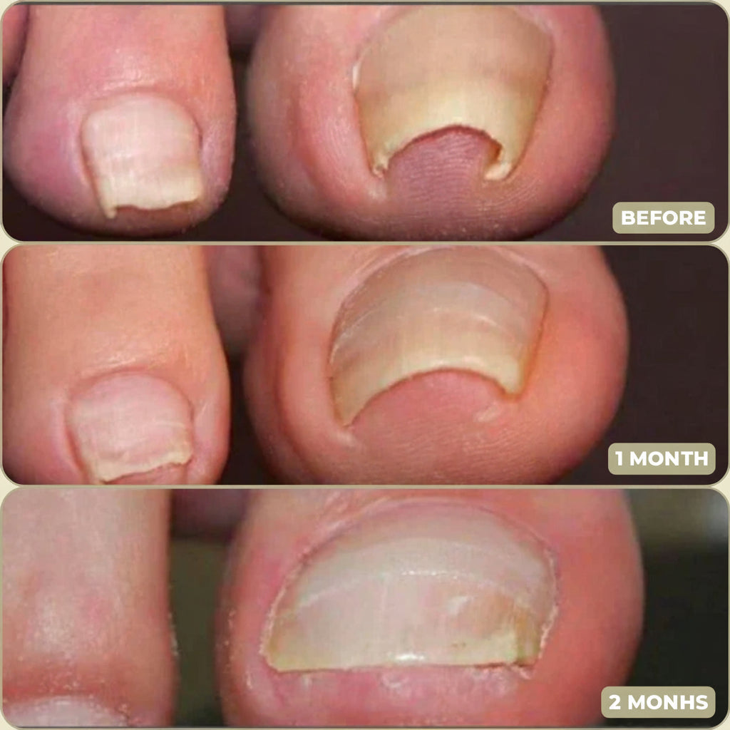 Toenail Corrector Patches Ingrown Nail